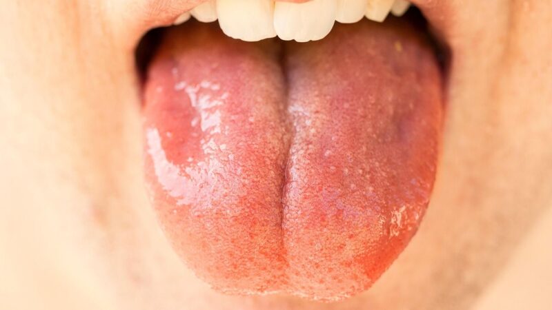 Ausreichender Speichelfluss, eine gesunde Mundflora und regelmäßige zahnmedizinische Prophylaxe sind wichtig für die Mundgesundheit.